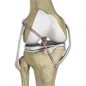 Multiligament Reconstruction of the Knee