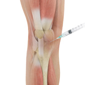 Cortisone injections